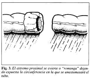 Tubo de Derivación Intracolónica