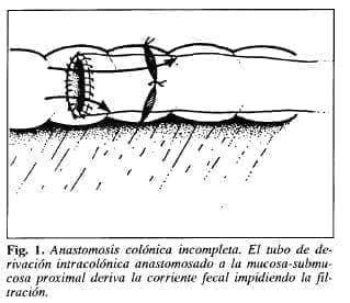 Anastomosis colónica incompleta - Tubo de Derivación Intracolónica