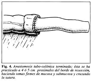 Anastomosis tubo-colónica terminada - Tubo de Derivación Intracolónica