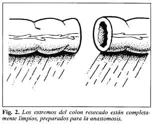 Colon preparado para la anastomosis -Tubo de Derivación Intracolónica