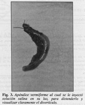 Apéndice vermiforme, visualizar del divertículo - Diverticulosis y Diverticulitis Apendicular  Apéndice vermiforme, visualizar del divertículo - Diverticulosis y Diverticulitis Apendicular
