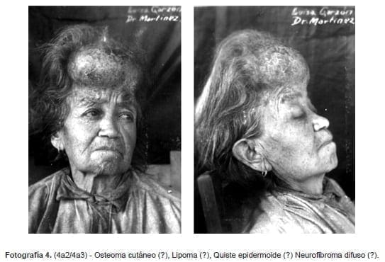 Osteoma cutáneo, Lipoma, Quiste epidermoide, Neurofibroma difuso, Fotográfica Sanmartín-Barberi Osteoma cutáneo, Lipoma, Quiste epidermoide, Neurofibroma difuso, Fotográfica Sanmartín-Barberi