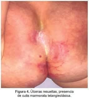 Cutis marmorata telangiectásica