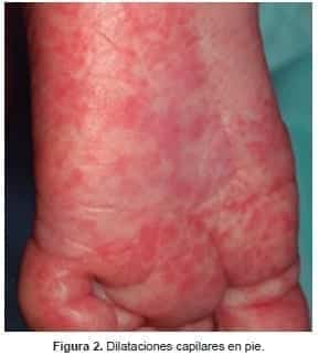 Dilataciones capilares en pie