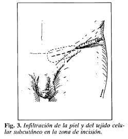 Infiltración de la piel y del tejido celular