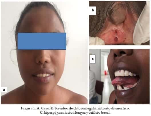 Residuo de clitoromegalia, introito dismorfico, Hiperplasia Suprarrenal Congénita