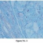 Carcinoma Renal de Células Cromófobas