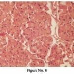 Carcinoma Renal de Células Cromófobas