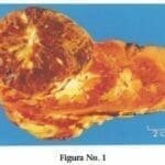 Carcinoma Renal de Células Cromófobas