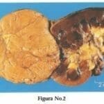 Carcinoma Renal de Células Cromófobas