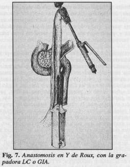 Anastomosis en Y de Roux, con la grapadora LC o GIA