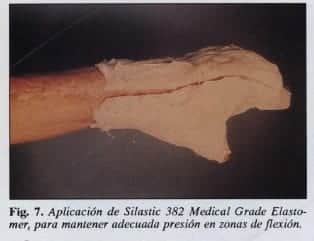 Expansión de los tejidos , Aplicación de Silastic 382