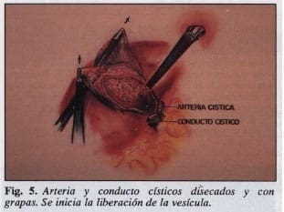Arteria y conducto císticos Arteria y conducto císticos