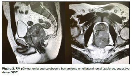Tumor del estroma gastrointestinal rectal, borramiento Tumor del estroma gastrointestinal rectal, borramiento
