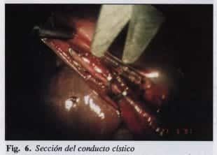 Sección del conducto cístico Sección del conducto cístico
