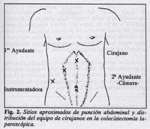 Sitios de punción abdominal Sitios de punción abdominal
