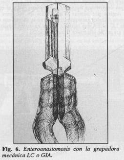 Enteroanastomosis con la grapadora mecánica LC o G/A