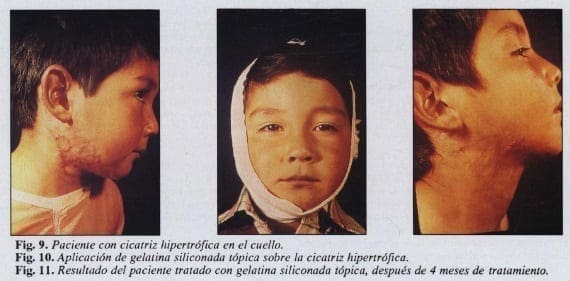 Resultados de la gelatina siliconada tópica