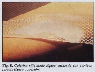 Gelatina siliconada tópica