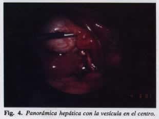 Panorámica hepática con la vesícula Panorámica hepática con la vesícula