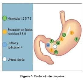 Protocolo de biopsias del Cáncer Gástrico