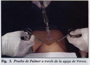 Prueba de Palmer Prueba de Palmer