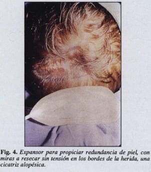 Expansión de los tejidos en cicatriz alopésica