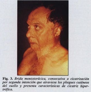 Cicatriz hipertrófica