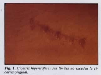 Cicatriz hipertrófica