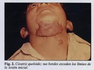 Cicatriz queloide