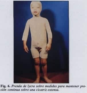 Expansión de los tejidos en cicatriz extensa