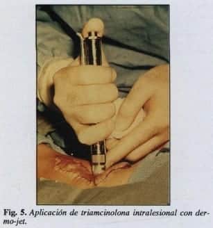 Aplicación de triamcinolona intralesional