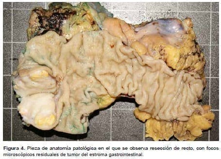 Tumor del estroma gastrointestinal Tumor del estroma gastrointestinal