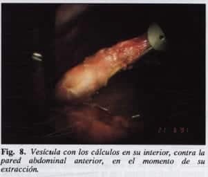 Vesícula con los cálculos en su interior Vesícula con los cálculos en su interior