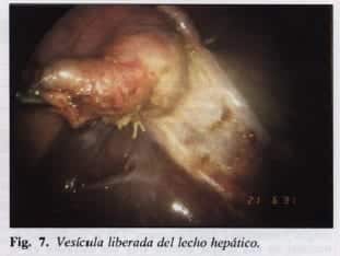 Vesícula liberada del lecho hepático Vesícula liberada del lecho hepático