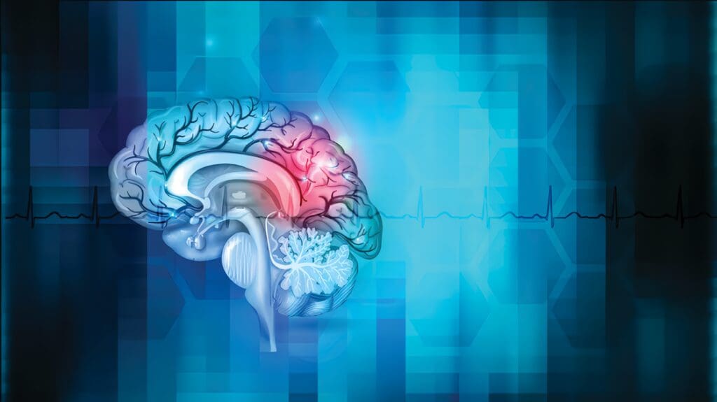 Accidente Cerebro Vascular o ACV