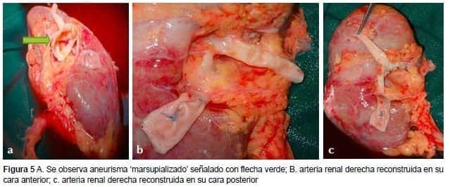 Aneurisma Marsupializado