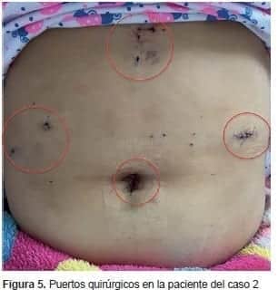 Puertos Quirúrgicos, Vólvulo Gástrico