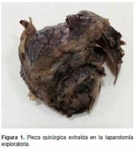 Pieza quirúrgica extraída en la laparotomía exploratoria Pieza quirúrgica extraída en la laparotomía exploratoria