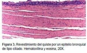 Revestimiento del Quiste por un epitelio Bronquial Revestimiento del Quiste por un epitelio Bronquial