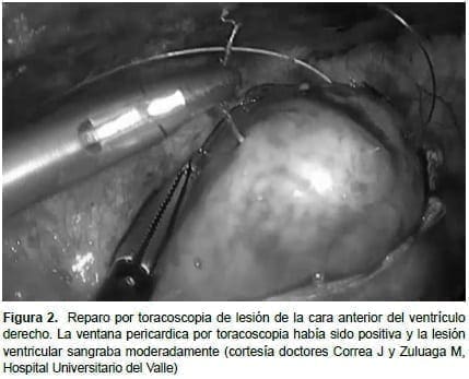 Toracoscopia de Lesión del Ventrículo derecho  Toracoscopia de Lesión del Ventrículo derecho