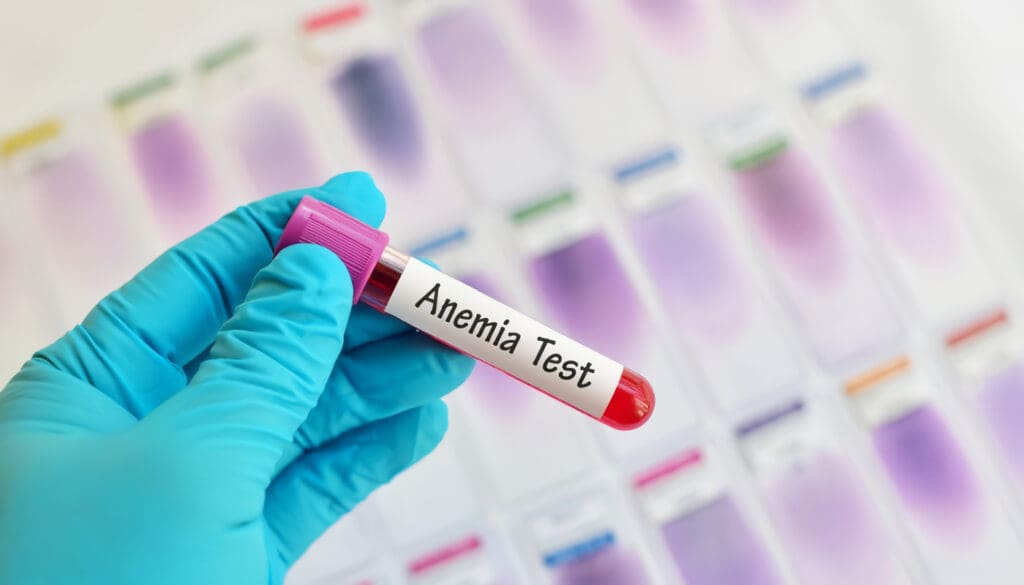 Anemia