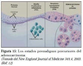 Estados Premalignos precursores del Adenocarcinoma Estados Premalignos precursores del Adenocarcinoma