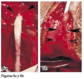 Injerto Tubulizado a la Uretra Posterior