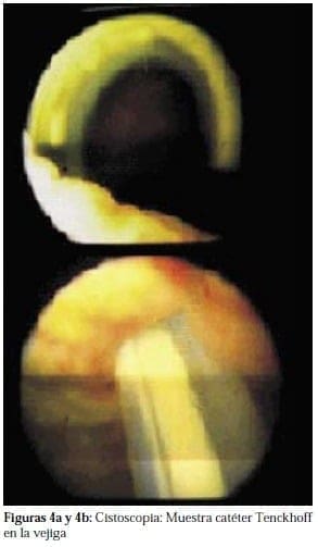 Cistoscopia: Muestra catéter Tenckhoff en la vejiga Cistoscopia: Muestra catéter Tenckhoff en la vejiga