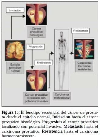 Fenotipo Secuencial del Cáncer de Próstata