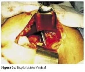 Exploración Vesical Exploración Vesical