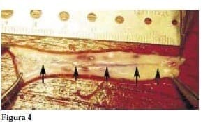 Injerto Suturados con puntos continuos con Ácido Poliglicólico Injerto Suturados con puntos continuos con Ácido Poliglicólico