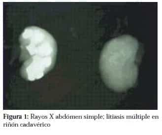 Litiasis Múltiple en Riñón Cadavérico Litiasis Múltiple en Riñón Cadavérico