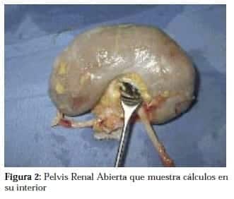 Pelvis Renal Abierta Pelvis Renal Abierta